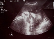 孕早期用微波炉会导致胎儿畸形吗（孕早期使用微波炉会致畸形吗）