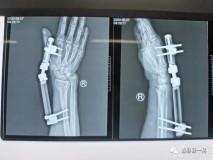 什么是开放性骨折（右踝开放性骨折严重吗）