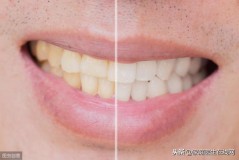 牙齿发黄是什么原因（去除牙黄的最快方法）