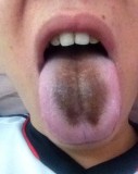 舌苔发黑是什么原因（舌苔发黑是大病前兆吗）