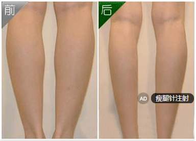 瘦腿针的副作用是什么
