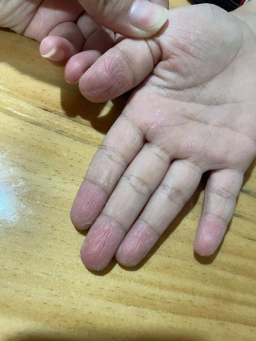 手指掉皮是怎么回事 如何治疗