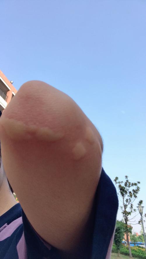 蚊子为什么那么喜欢咬我的腿而不是咬我的脸