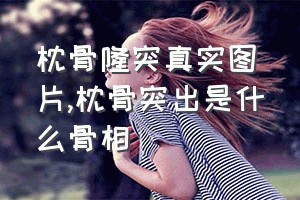 枕骨隆突真实图片（枕骨突出是什么骨相）